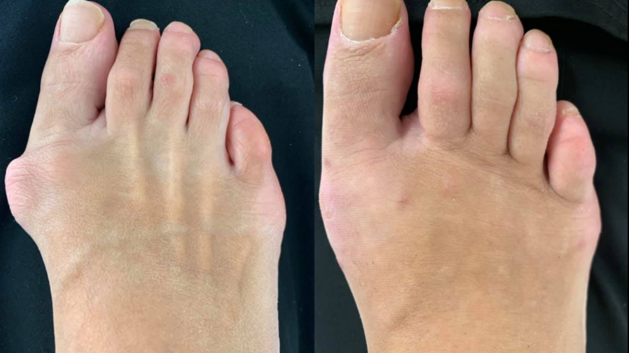 Surgical Corrections of Foot Disorders in Navarre, Milton, & Gulf
